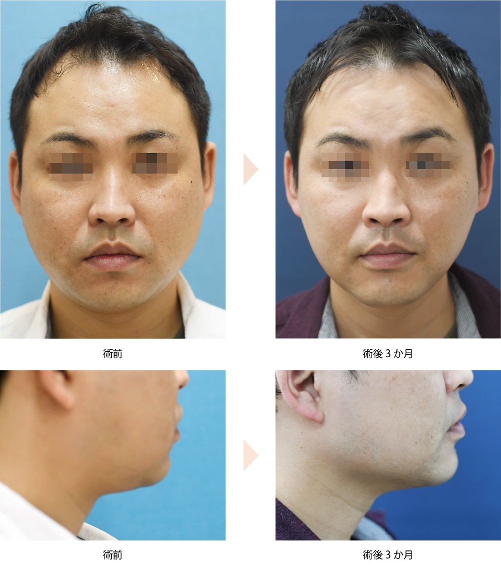 クールスカルプティング（脂肪冷却マシンによる小顔治療）の症例写真・ビフォーアフター