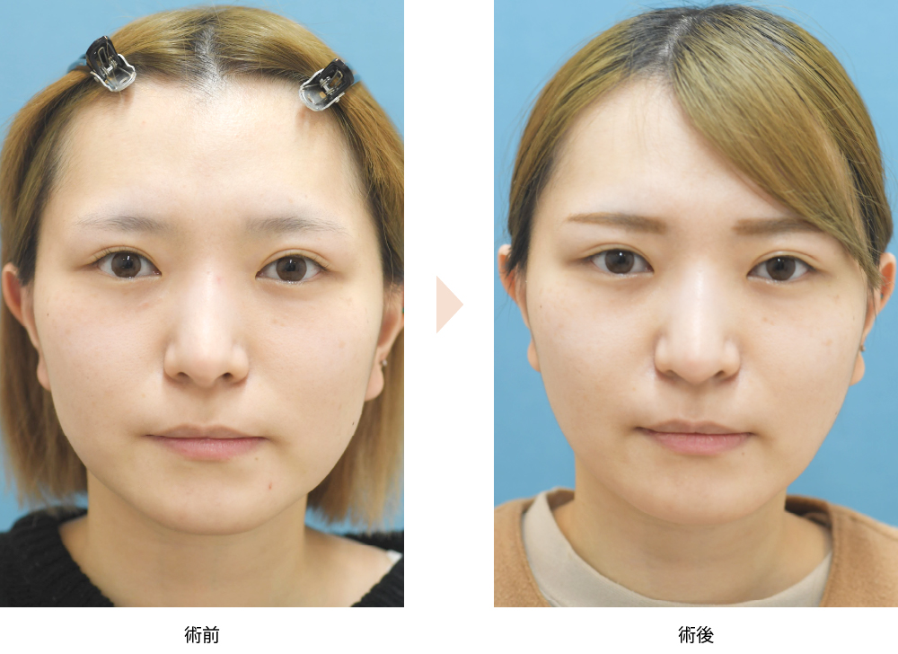 頬のベイザー脂肪吸引／糸リフト併用（No.224）（ベイザーによるジョールファット脂肪吸引）の症例写真・ビフォーアフター