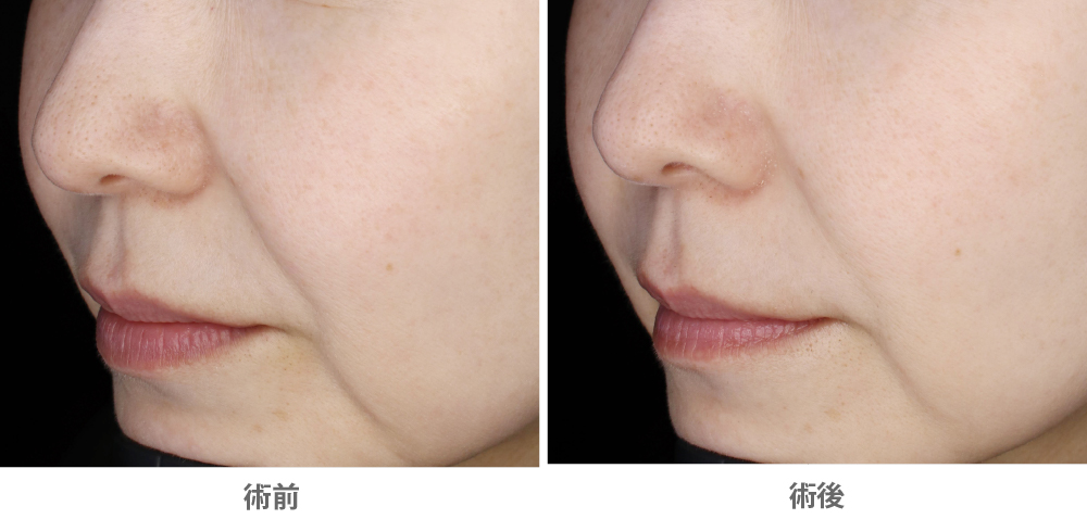 ソフウェーブ（ほうれい線治療／40代女性）の症例写真・ビフォーアフター