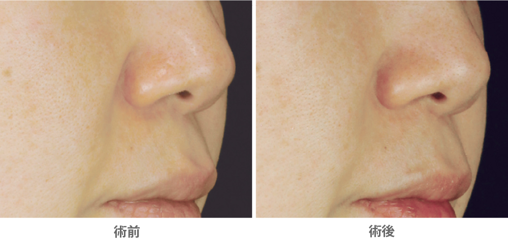 ソフウェーブ（ほうれい線治療／40代女性）の症例写真・ビフォーアフター