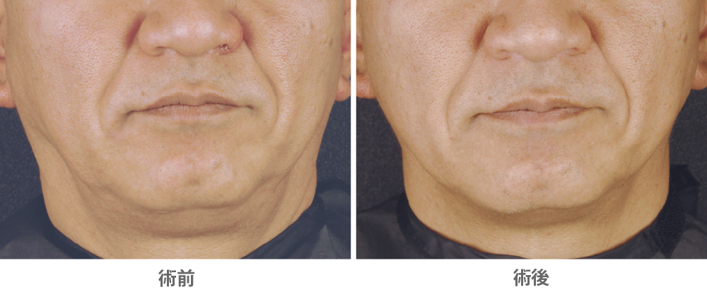 ソフウェーブ（顎下のたるみ治療／50代男性）の症例写真・ビフォーアフター