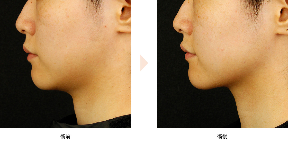 サーマクールFLX（高周波による顎下のたるみ治療）の症例写真・ビフォーアフター
