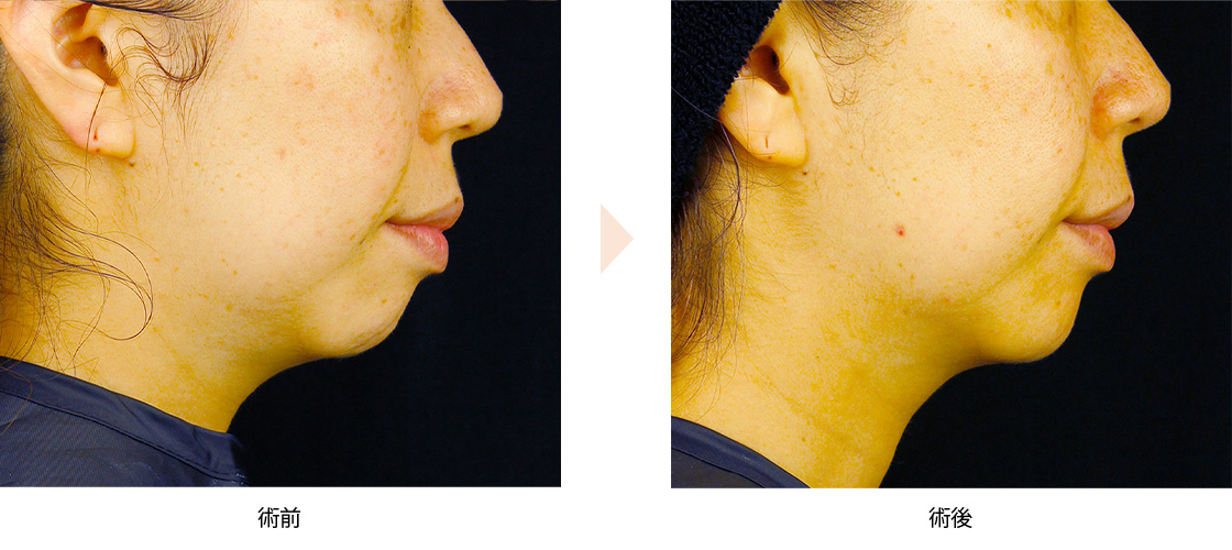 サーマクールFLX（高周波による顎下のたるみ治療）の症例写真・ビフォーアフター