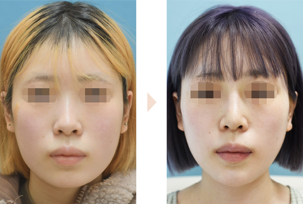 Vライン形成（小顔整形＋顎の左右差改善）の症例写真・ビフォーアフター