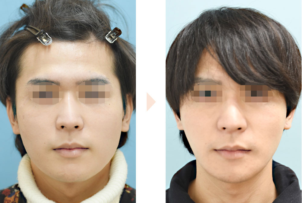 Vライン形成（他院オトガイ形成術後の修正術）の症例写真・ビフォーアフター