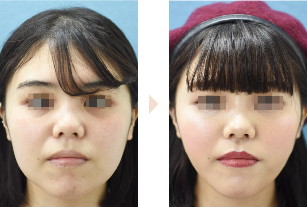 下膨れ顔をVラインに改善（頬の脂肪吸引／ジョールファット除去）の症例写真・ビフォーアフター