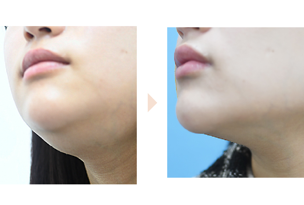 唾液腺ボトックスによる小顔治療（舌下腺・顎下腺）の症例写真・ビフォーアフター