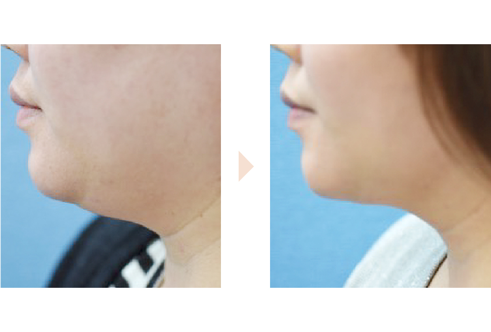 顔周り全体の脂肪吸引による小顔治療（頬・顎下の脂肪吸引）の症例写真・ビフォーアフター