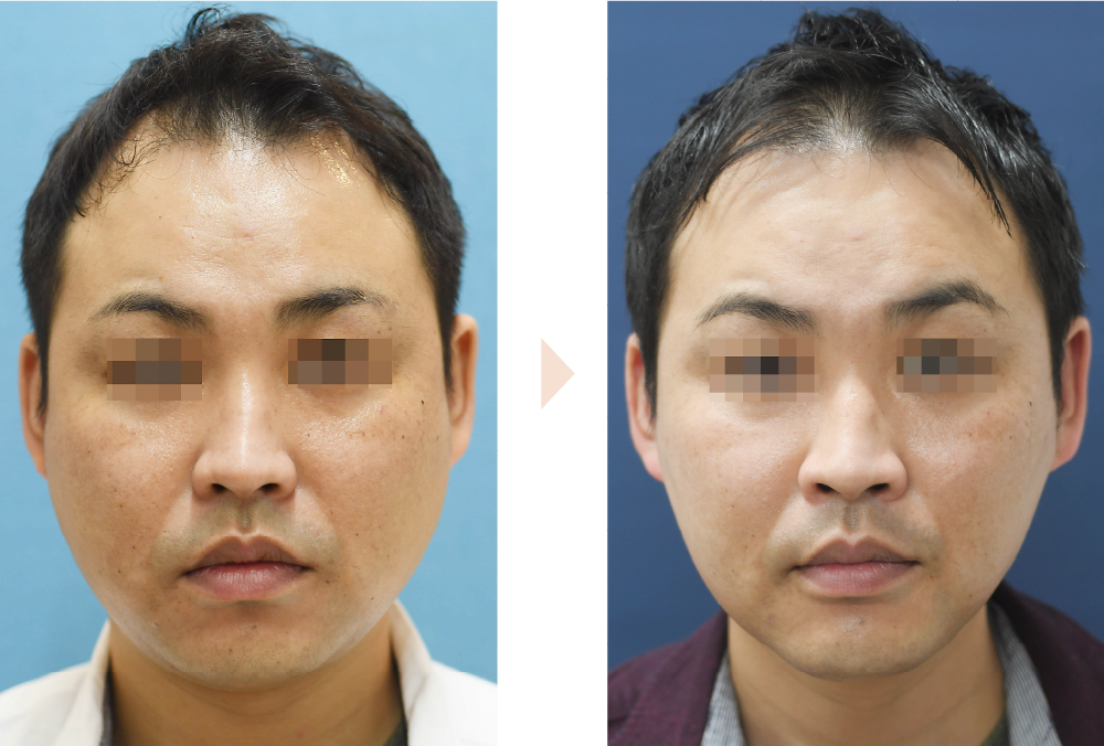 1回のクルスカ治療で頬・顎下をシャープに（クールスカルプティング・エリート／頬・顎下）の症例写真・ビフォーアフター