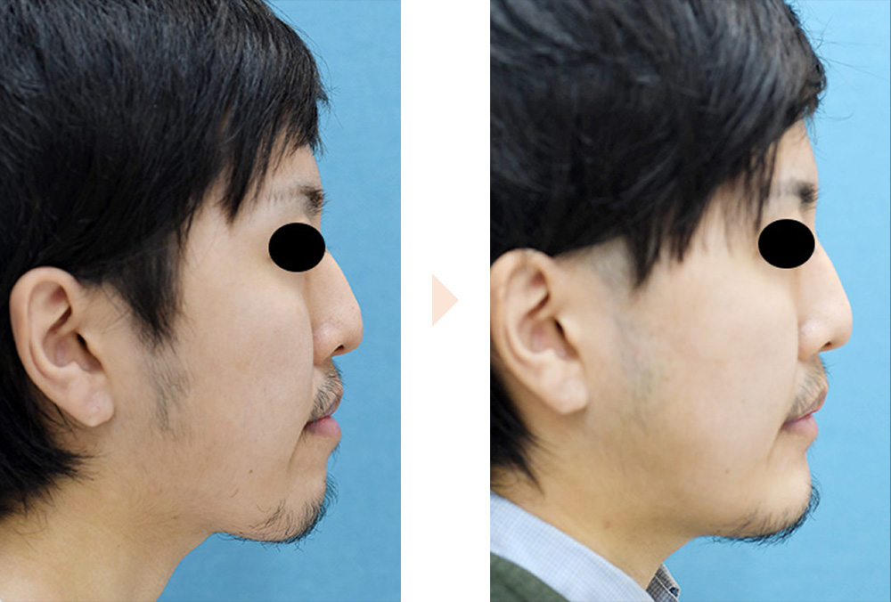 受け口・あごの長さ改善（下セットバック・オトガイ形成）の症例写真・ビフォーアフター