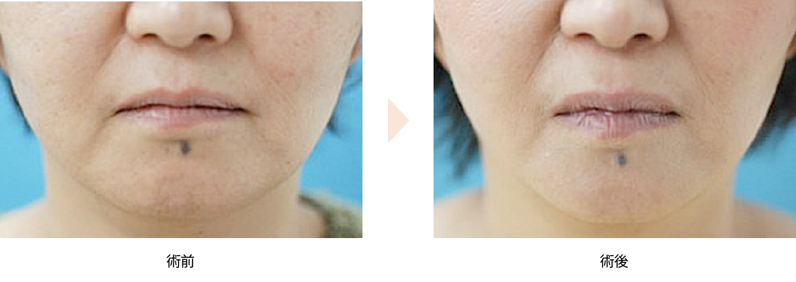 ウルセラリフト（No.277）（HIFU治療による頬・フェイスラインたるみ引き締め）の症例写真・ビフォーアフター