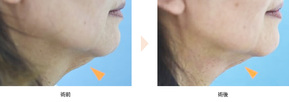 ウルセラリフト（No.282）（HIFU治療による顎下・首のたるみ引き締め）の症例写真・ビフォーアフター