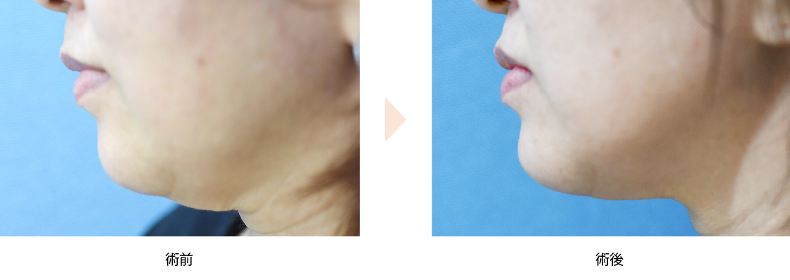 ウルセラリフト（No.284）（HIFU治療による顎下のたるみ引き締め）の症例写真・ビフォーアフター