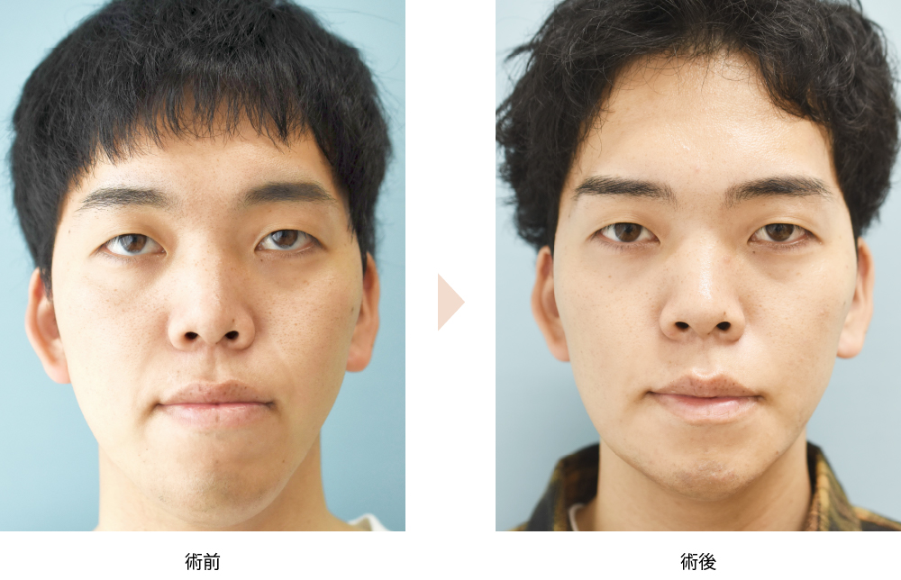 下顎セットバック＋オトガイ形成 （No.179）の症例写真・ビフォーアフター
