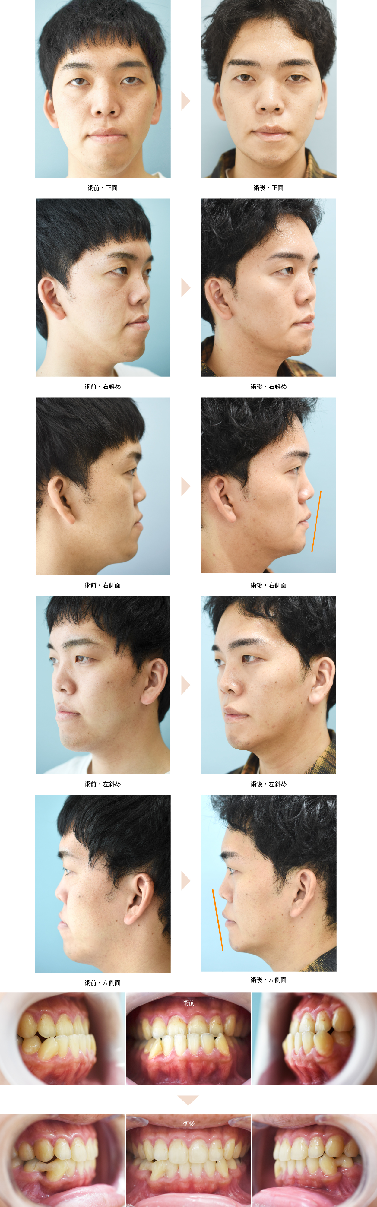 下顎セットバック＋オトガイ形成 （No.179）の症例写真・ビフォーアフター