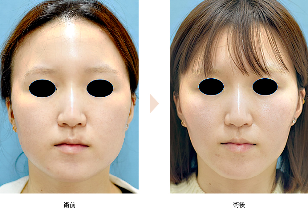 頬のベイザー脂肪吸引／バッカルファット除去併用（No.221）（ベイザーによるジョールファット除去）の症例写真・ビフォーアフター