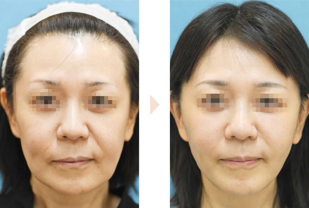 ジョールファット除去＋糸リフト（中顔面～下顔面のたるみ取り）の症例写真・ビフォーアフター