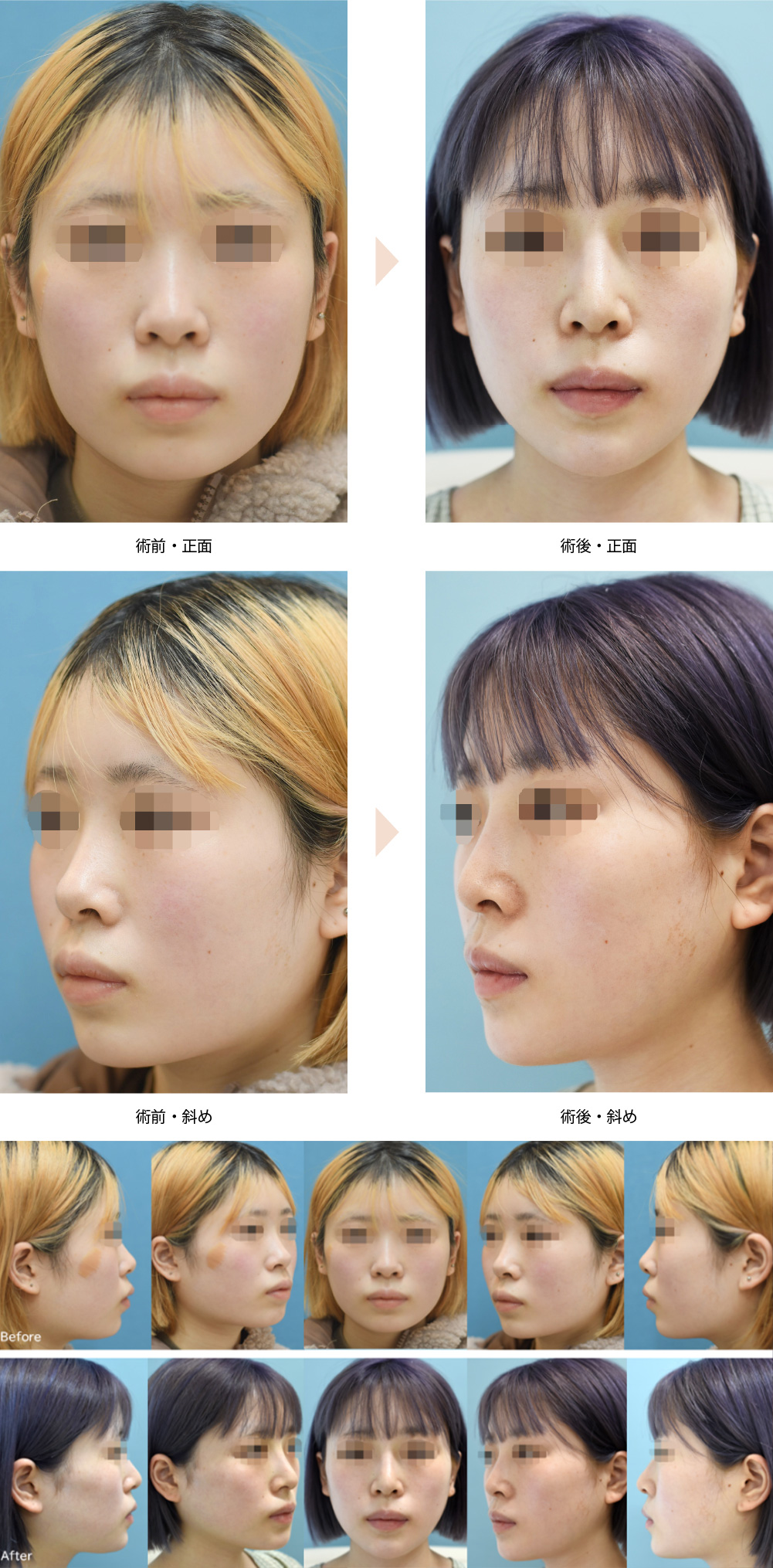 Vライン形成術（小顔整形）（エラ張りが目立つ方の小顔整形）の症例写真・ビフォーアフター