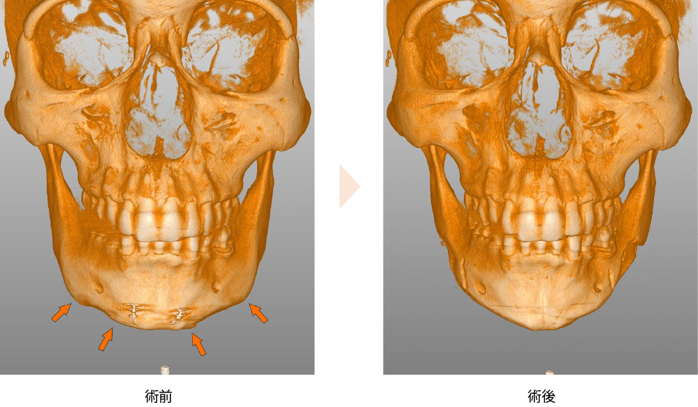 Vライン形成術（No.335）（他院オトガイ形成術後の修正術）の症例写真・ビフォーアフター