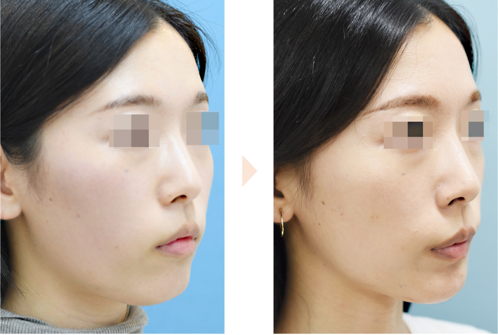 Vライン形成（小顔整形＋左右差改善）の症例写真・ビフォーアフター