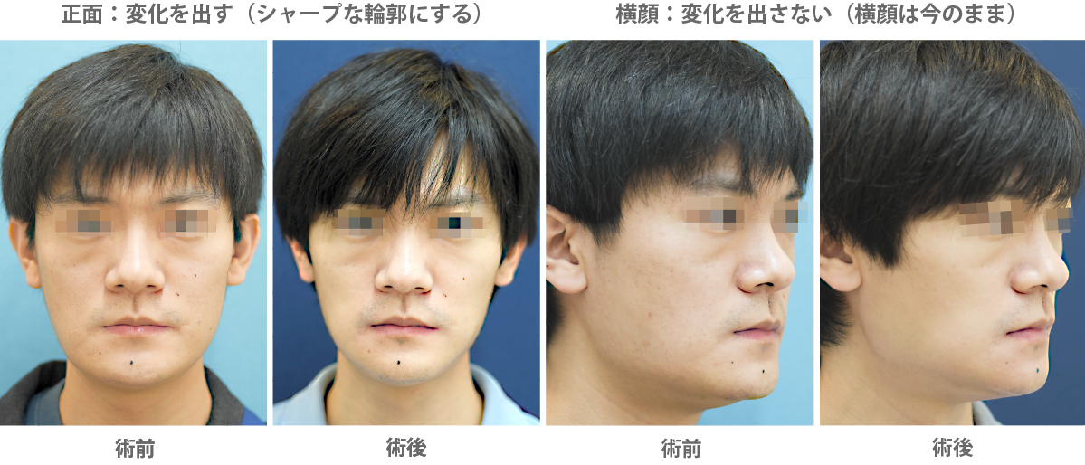 カスタマイズVライン形成術症例（正面だけ小顔に・横顔には変化を出さない）の症例写真・ビフォーアフター