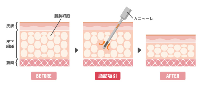 脂肪吸引の仕組み