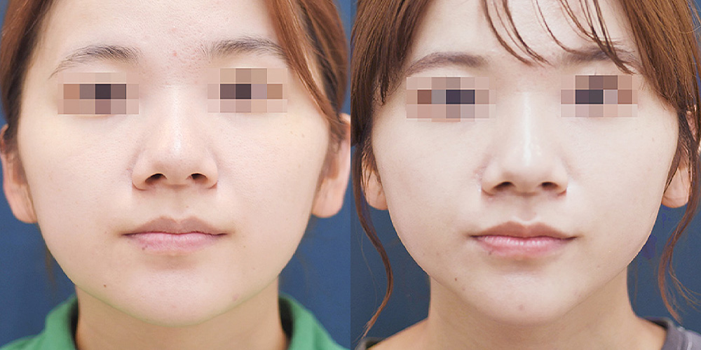 ジョールファット除去による小顔・Vライン形成