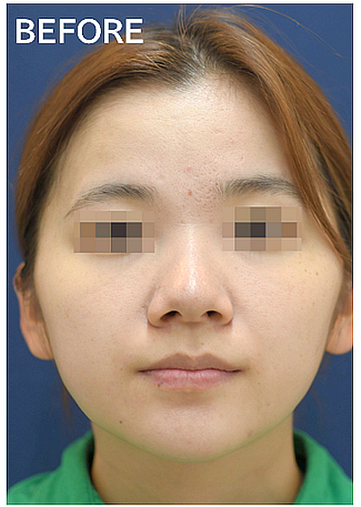 ョールファット除去によるVライン形成症例