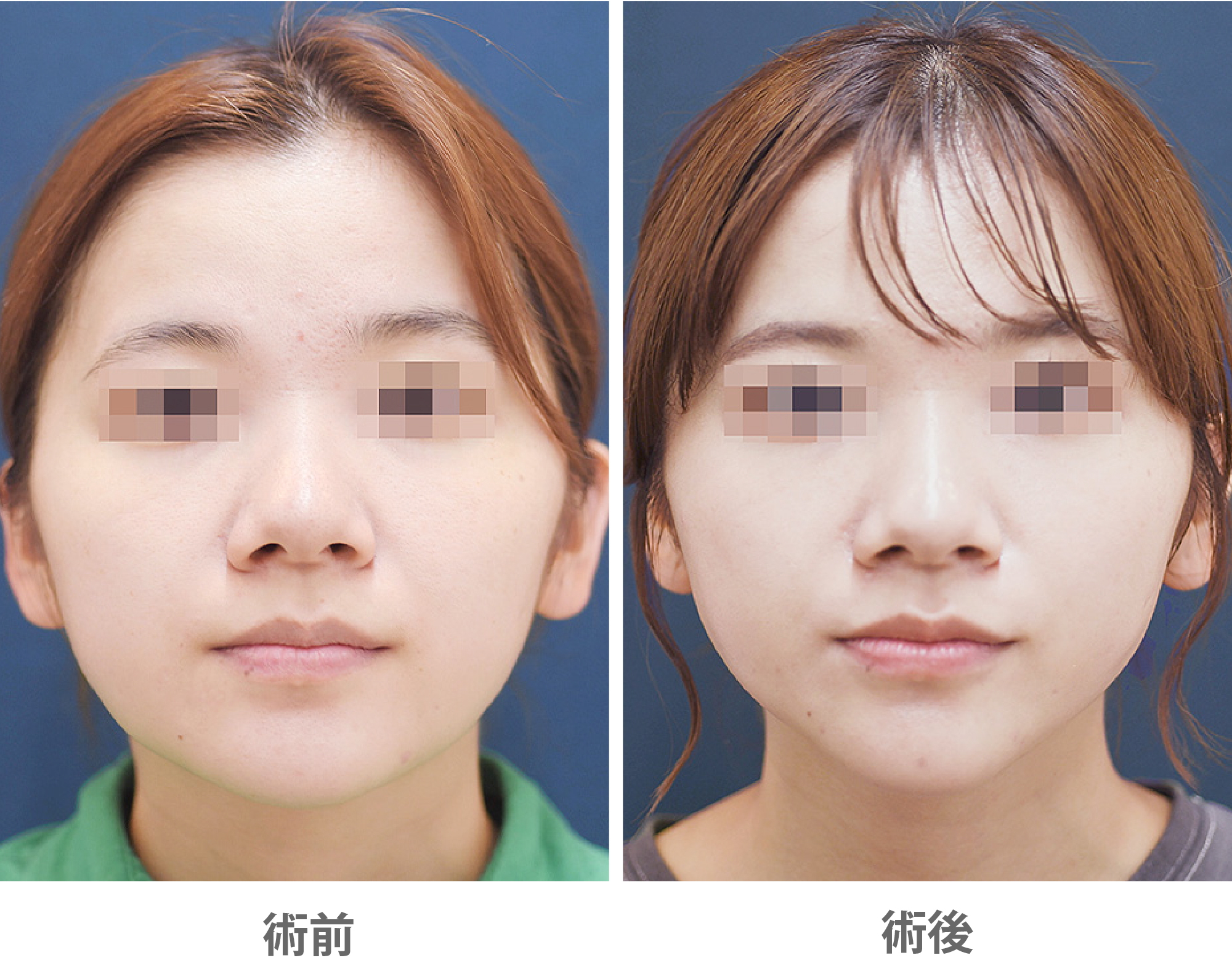 ジョールファット除去によるVライン形成の症例写真・ビフォーアフター