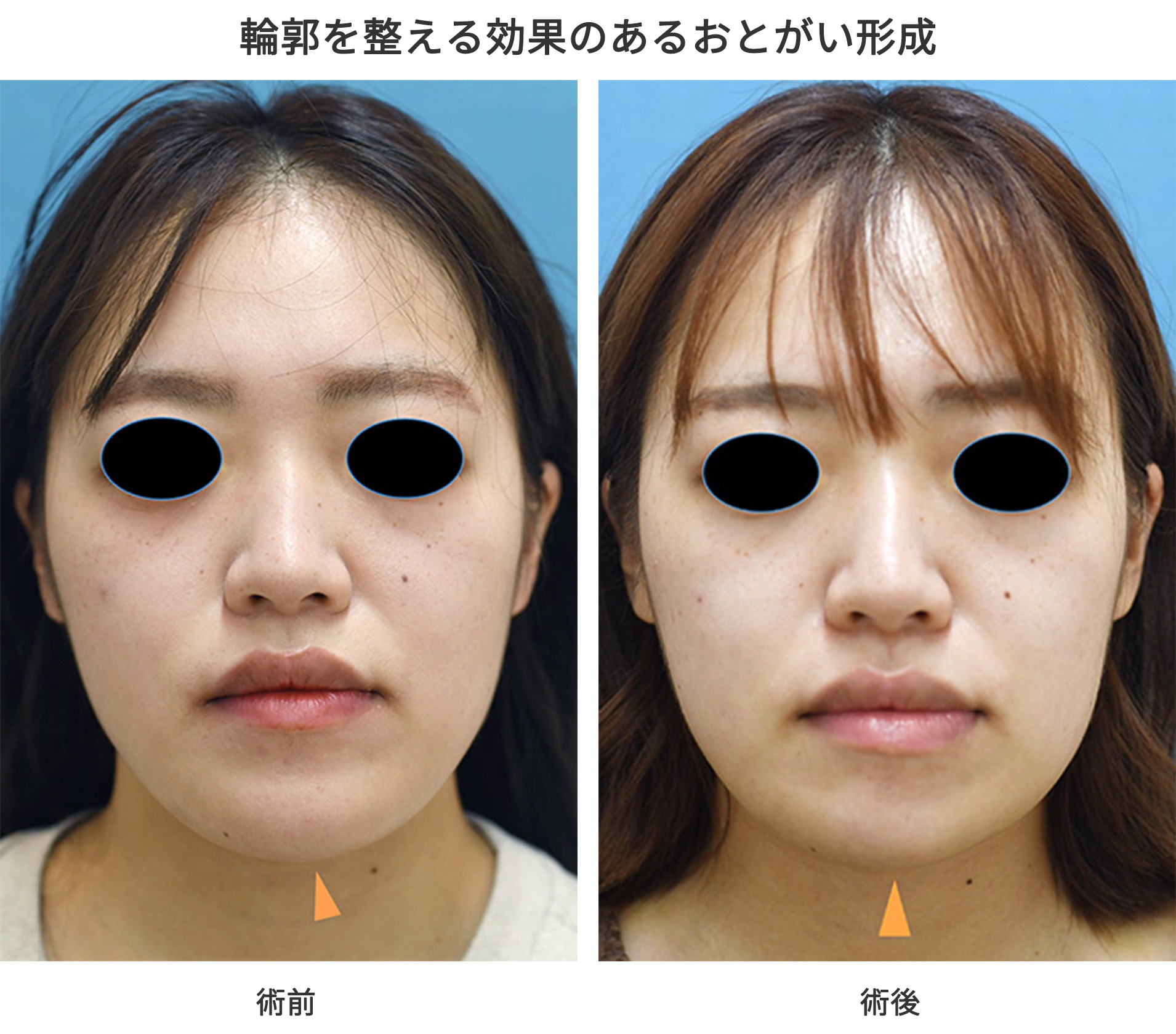 輪郭を整える効果のあるおとがい形成の症例写真・ビフォーアフター