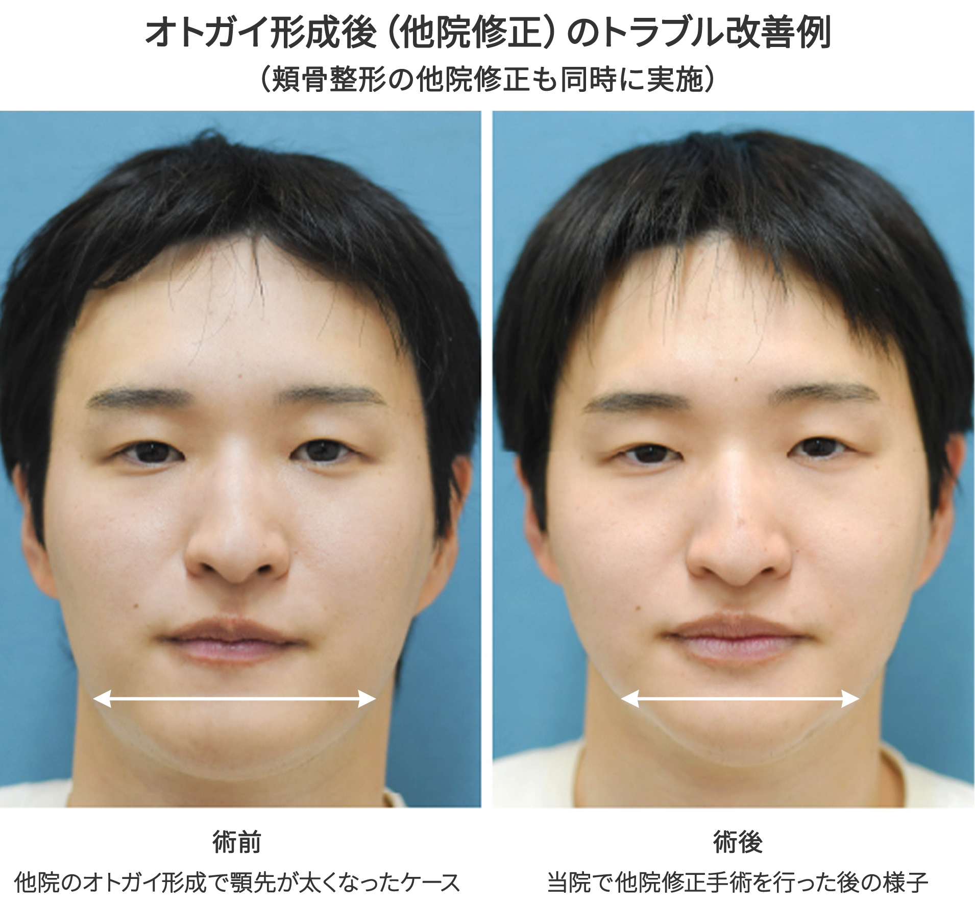 オトガイ形成後(他院修正)のトラブル改善例