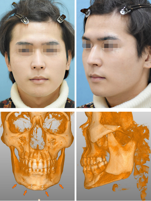 他院修正術(オトガイ形成の修正)の修正手術前の様子