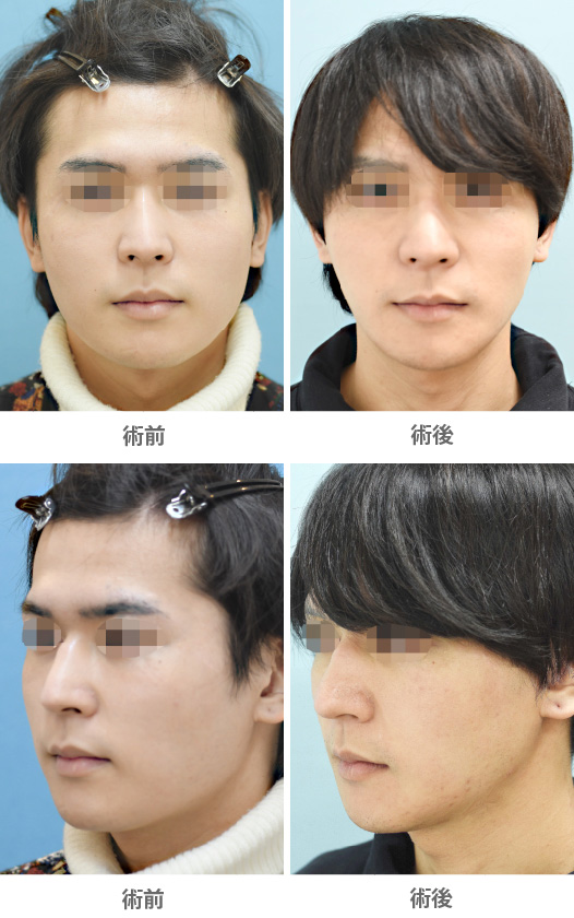 他院修正術(オトガイ形成の修正)の症例写真・ビフォーアフター