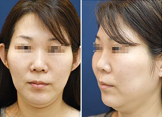 44歳女性|輪郭(頬+顎下)の脂肪吸引症例