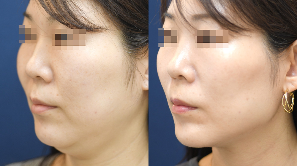 【40代女性】輪郭の脂肪たるみ|頬・顎下の脂肪吸引による改善症例