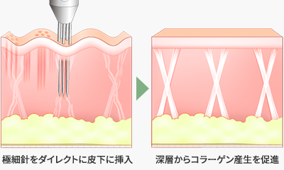 顎下のたるみ・二重あごの原因にダイレクトに照射