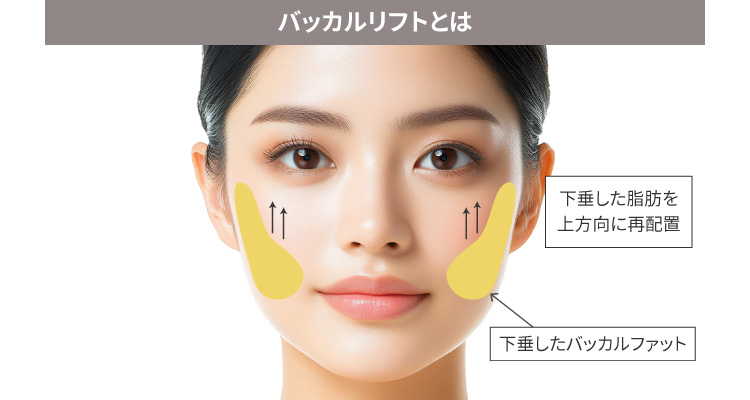バッカルリフトとは