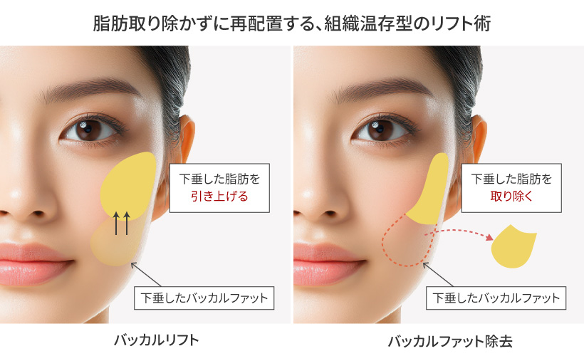バッカルファット除去との違い