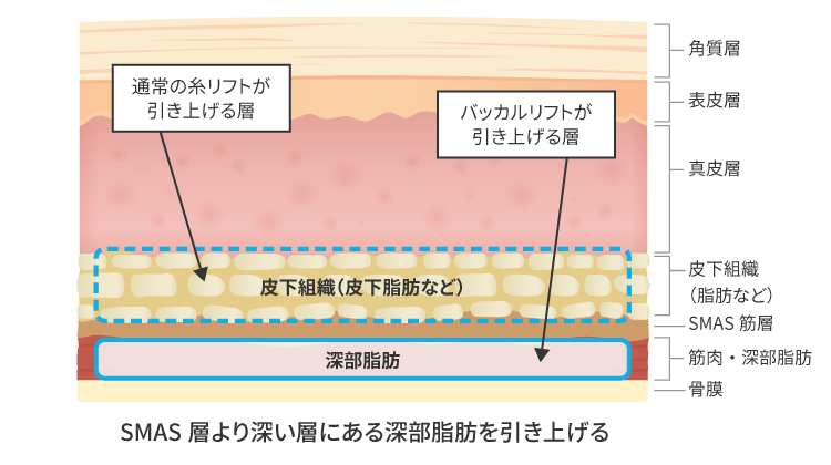 糸リフトとの違い