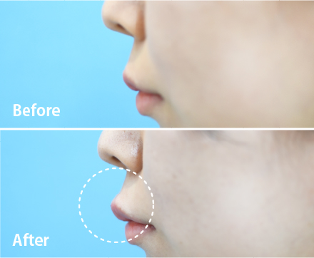 人中短縮術とは