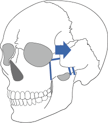 頬骨の後方移動