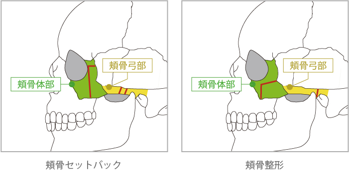 〇主な頬骨整形について