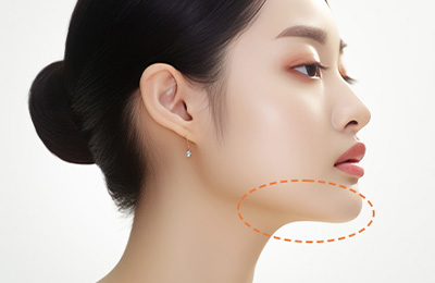 顎下のたるみ取り