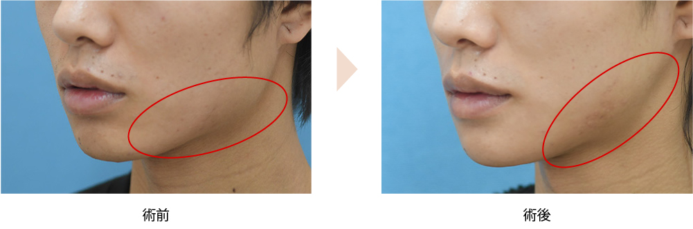 下顎下縁へのアプローチが滑らかな小顔を形成するポイント