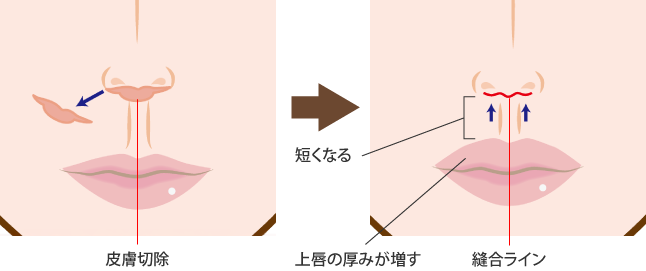 人中短縮術とは