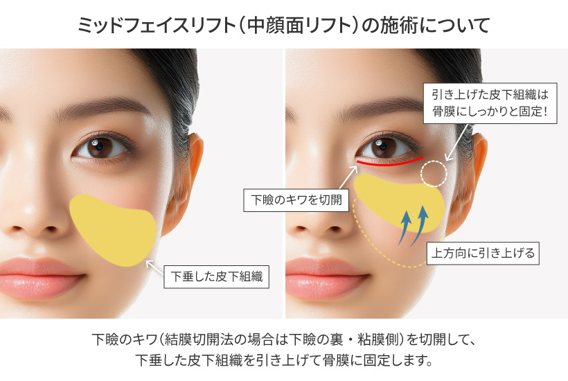 ミッドフェイスリフトとは
