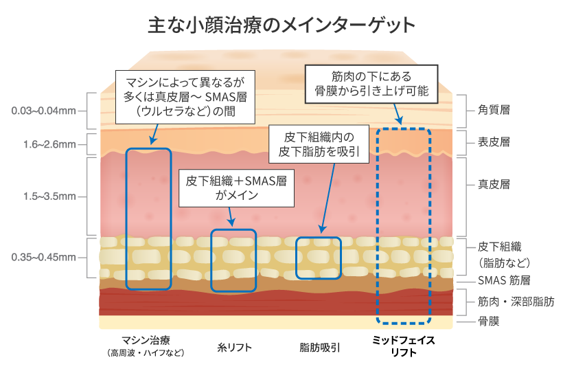 レーザーや糸リフトでは届かない「皮下深層」にアプローチ
