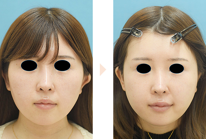 頬骨骨切り・骨削りによる頬骨整形（No.104）（頬の前方と横方向への突出・顔の左右幅改善）の症例写真・ビフォーアフター