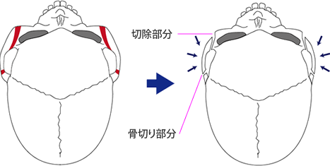 頬骨整形（頬骨体部の骨削り＋頬骨弓部の骨切り）のイメージ