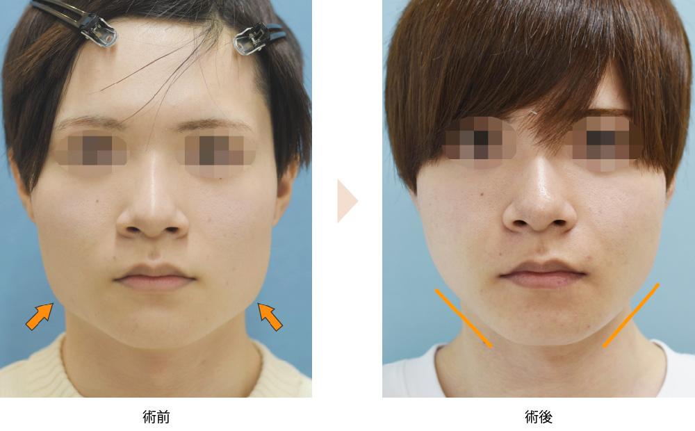 外板切除併用例